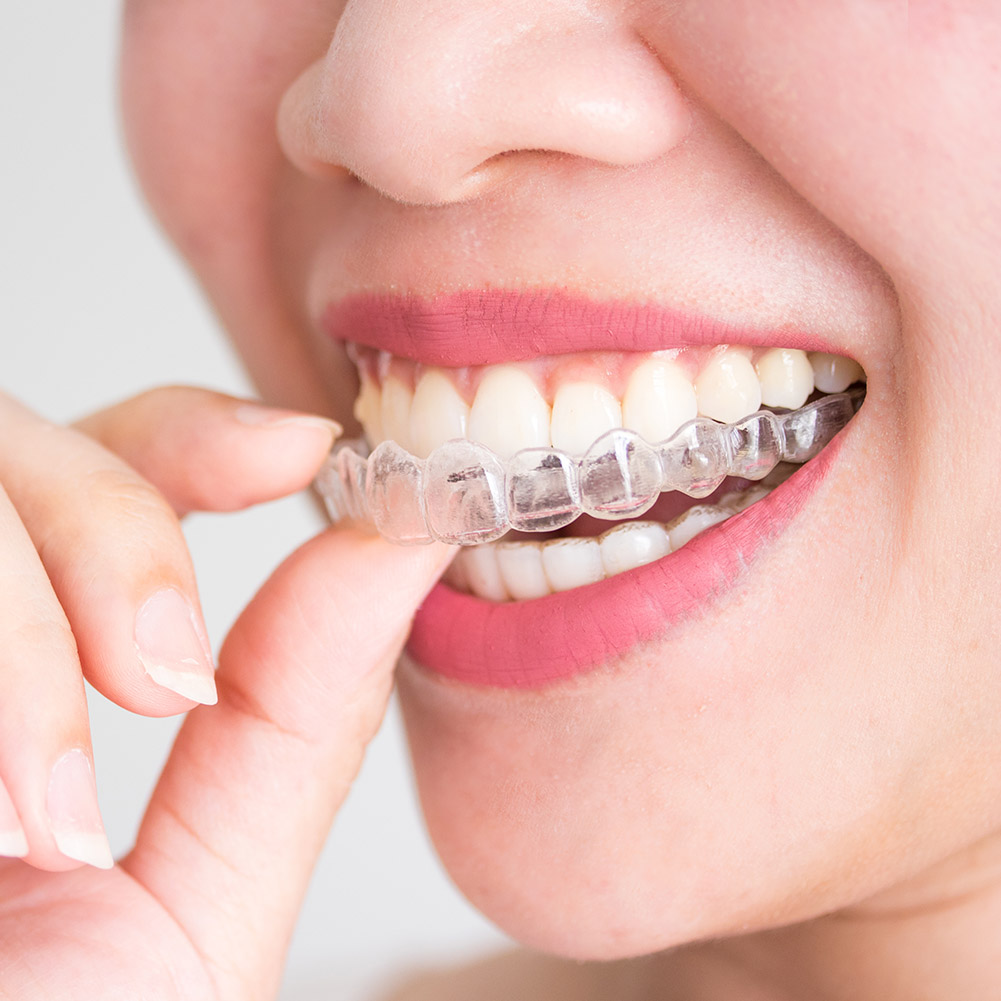 Teeth Whitening With Trays - 2/4pcs Mouth Guard Teeth Protector Guard