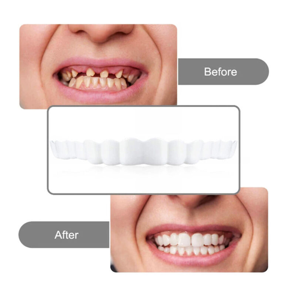 licone Denture Set Fit Tempora - đánh giá và giá Teeth Whitening Usa