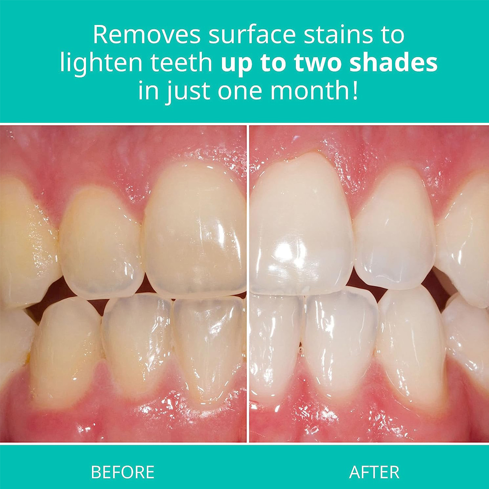 Opalescence Whitening Toothpas - đánh giá và giá Teeth Whitening Opalescence