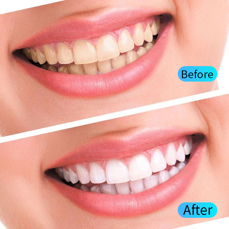 Teeth Whitening Gel Kit Oral H - đánh giá và giá Teeth Whitening Opalescence