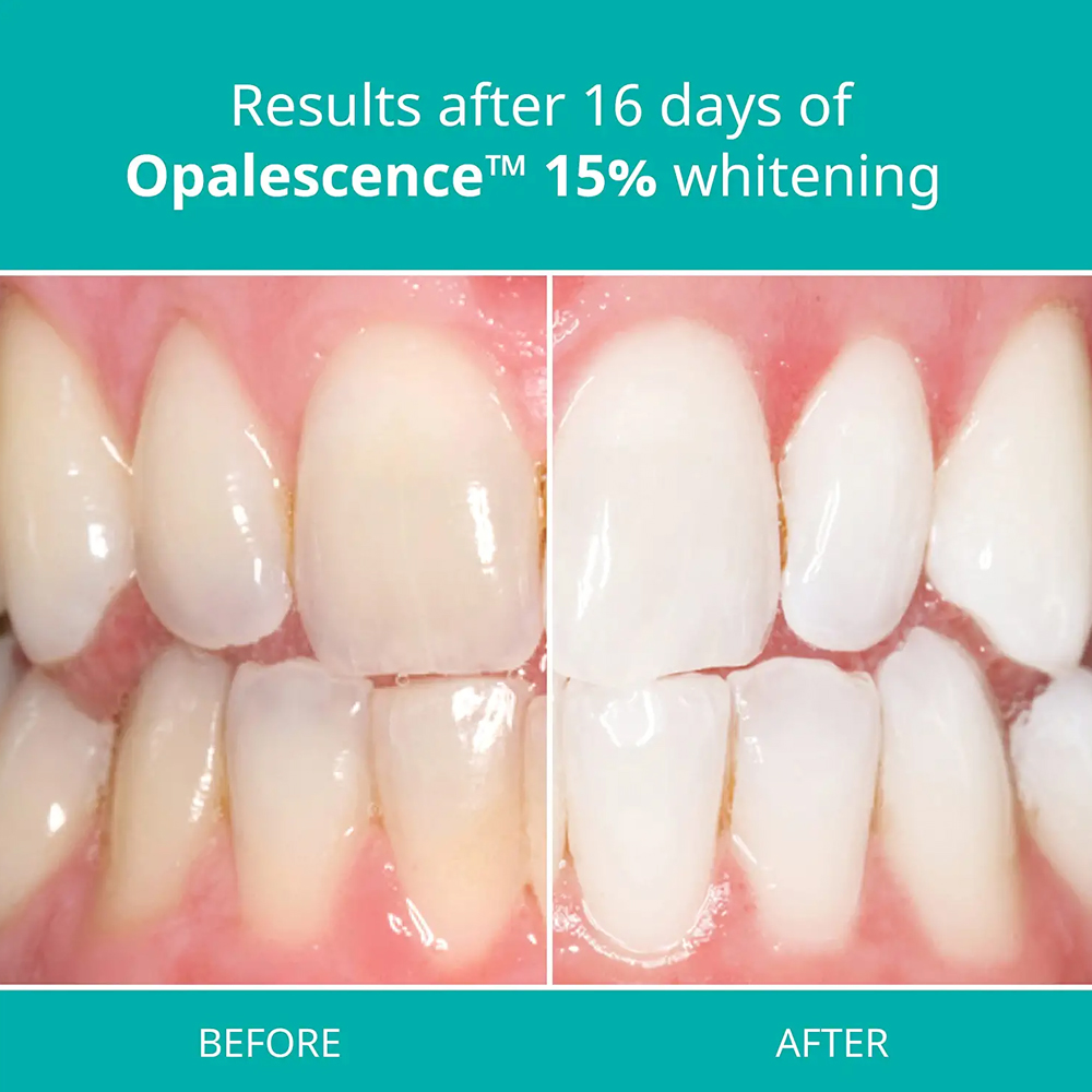Opalescence Professional White - đánh giá và giá Teeth Whitening Opalescence
