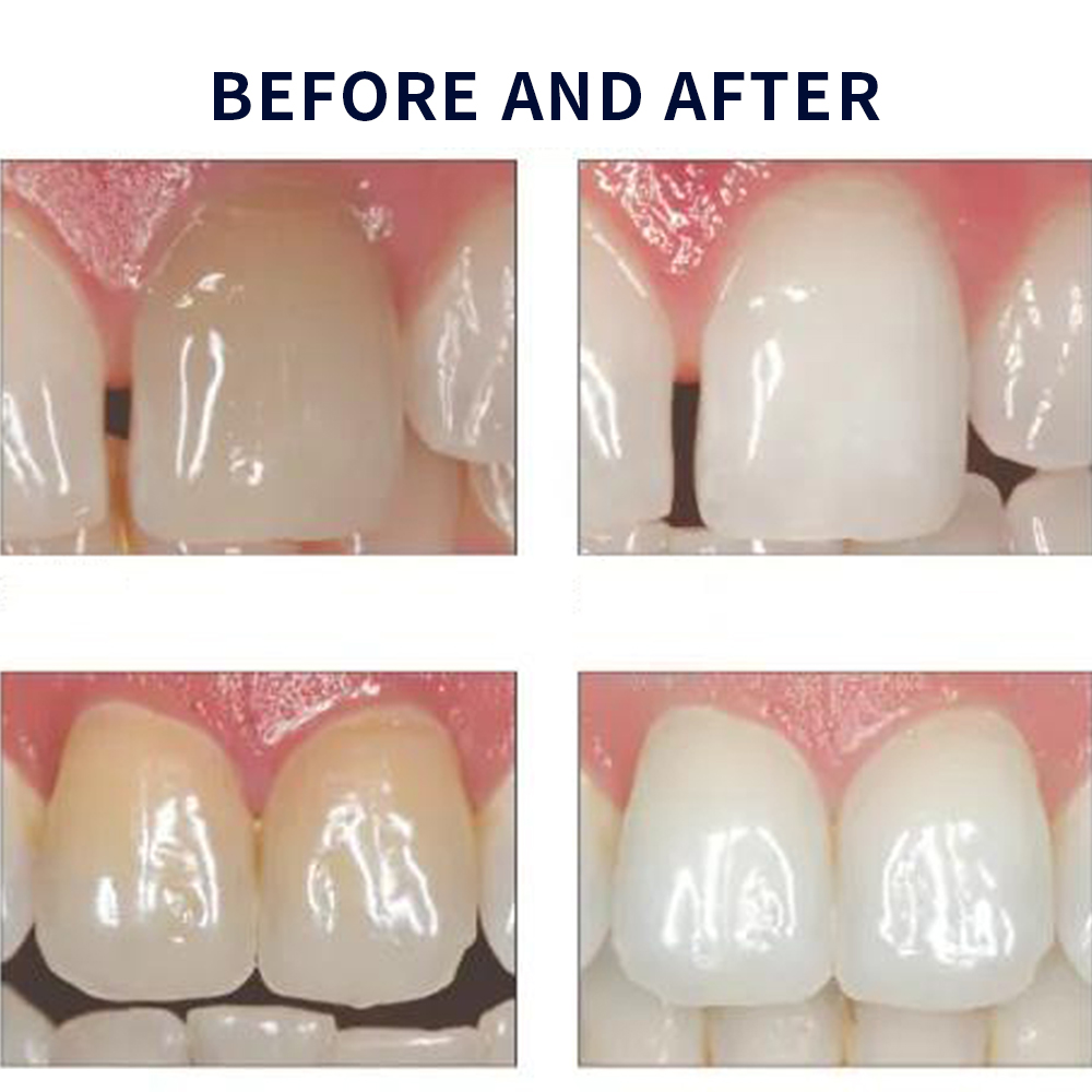 Opalescence Whitening 20% PF 2 - đánh giá và giá Teeth Whitening Opalescence