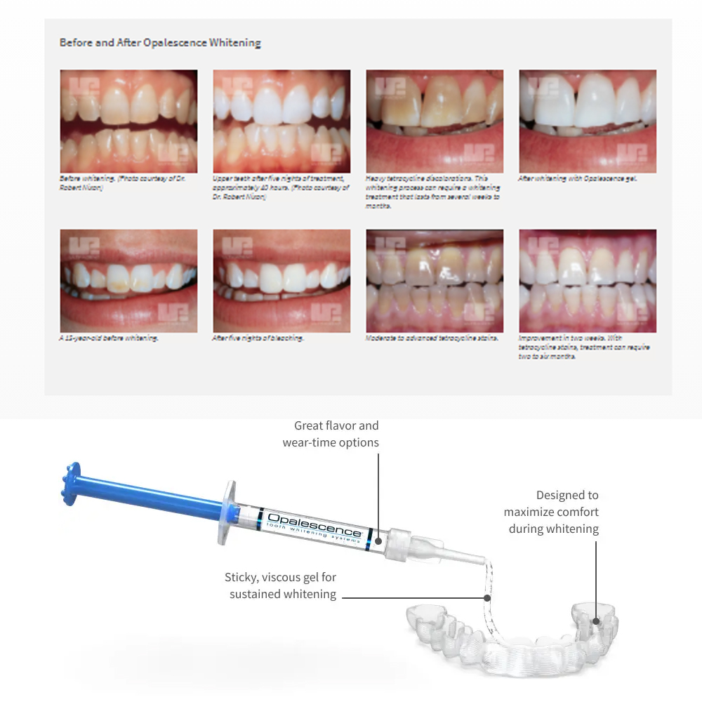 Opalescence Whitening 20% PF 2 - đánh giá và giá Teeth Whitening Opalescence