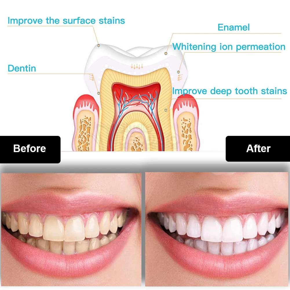 Dental Teeth Whitening Kit Min - đánh giá và giá Teeth Whitening Vape